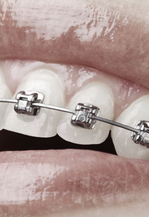 brackets-de-autoligado-baja-friccion-albacete