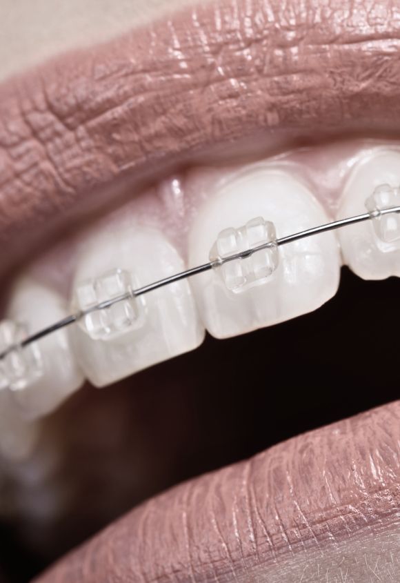 brackets-esteticos-transparentes