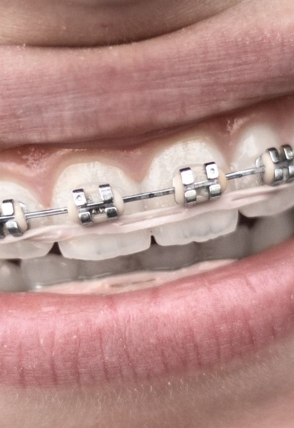 brackets-metalicos-tradicionales