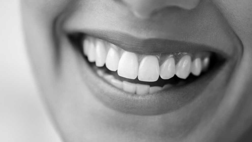 carillas-dentales-en-albacete-raga-clinica-dental