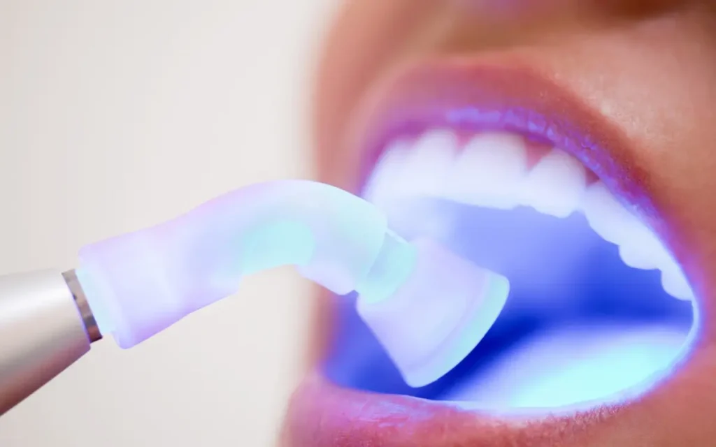 Blanqueamiento Dental Albacete