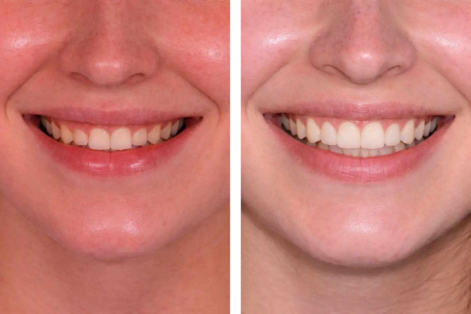 Sonrisa antes y después de tratamiento de alargamiento de corona para dientes cortos o con mucha encía