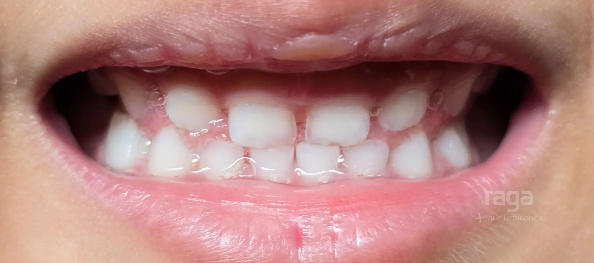 Boca con dientes cortos por exceso de encías