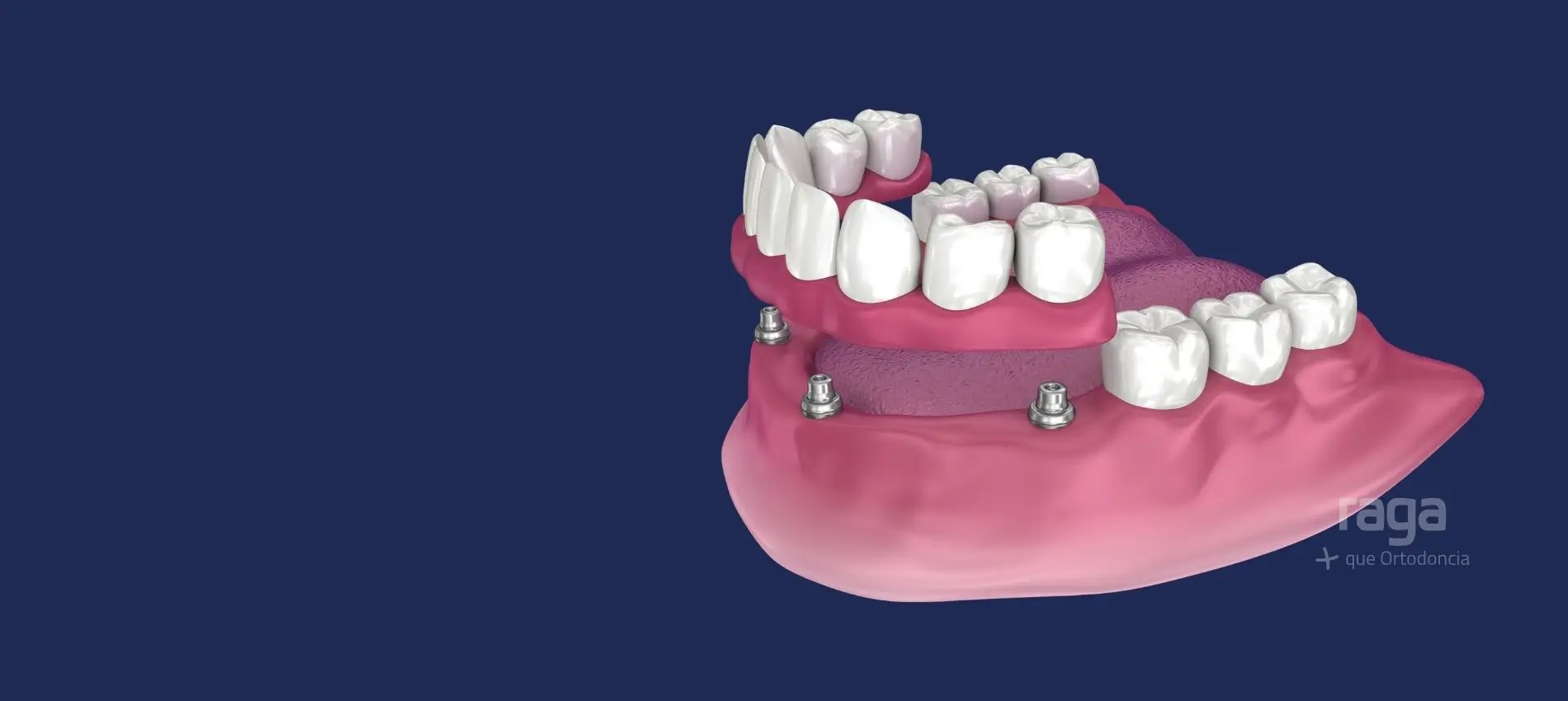 Boca con 4 implantes: implantes All-on-4 en Albacete