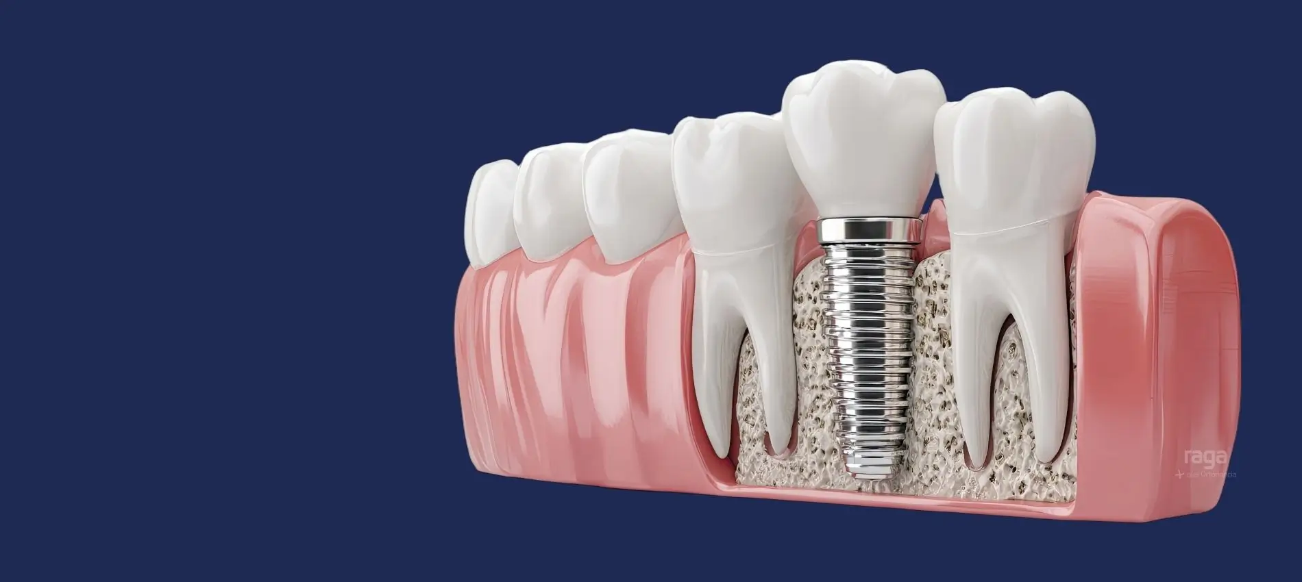 Implantes dentales con poco hueso: ejemplo de implante