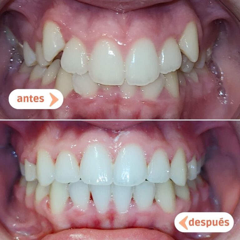 Dientes torcidos antes y después del tratamiento de ortodoncia en Albacete