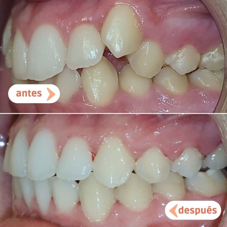 Maloclusión dental y dientes apiñados antes y después del tratamiento con ortodoncia en Raga Albacete