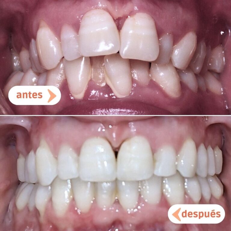 Antes y después del tratamiento de ortodoncia en Albacete: boca con apiñamiento severo