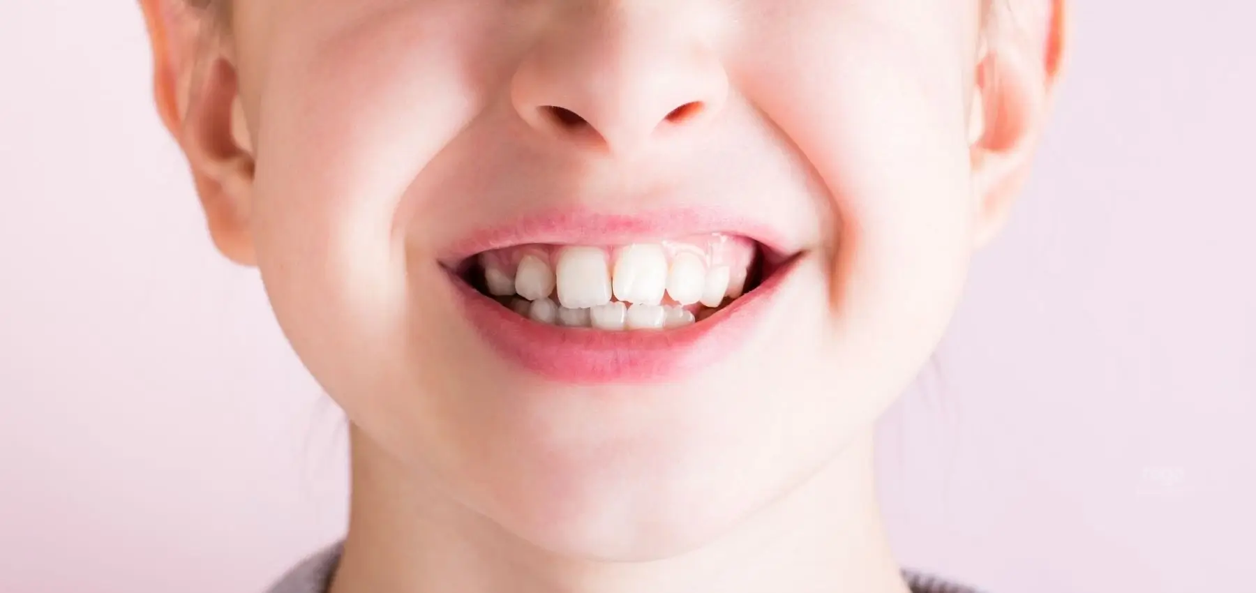 Mordida cruzada en niños: dientes que no encajan