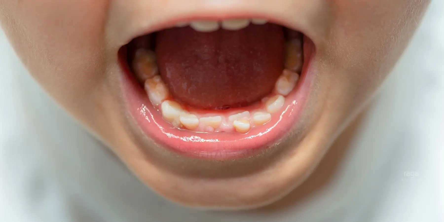 Paladar estrecho en niños