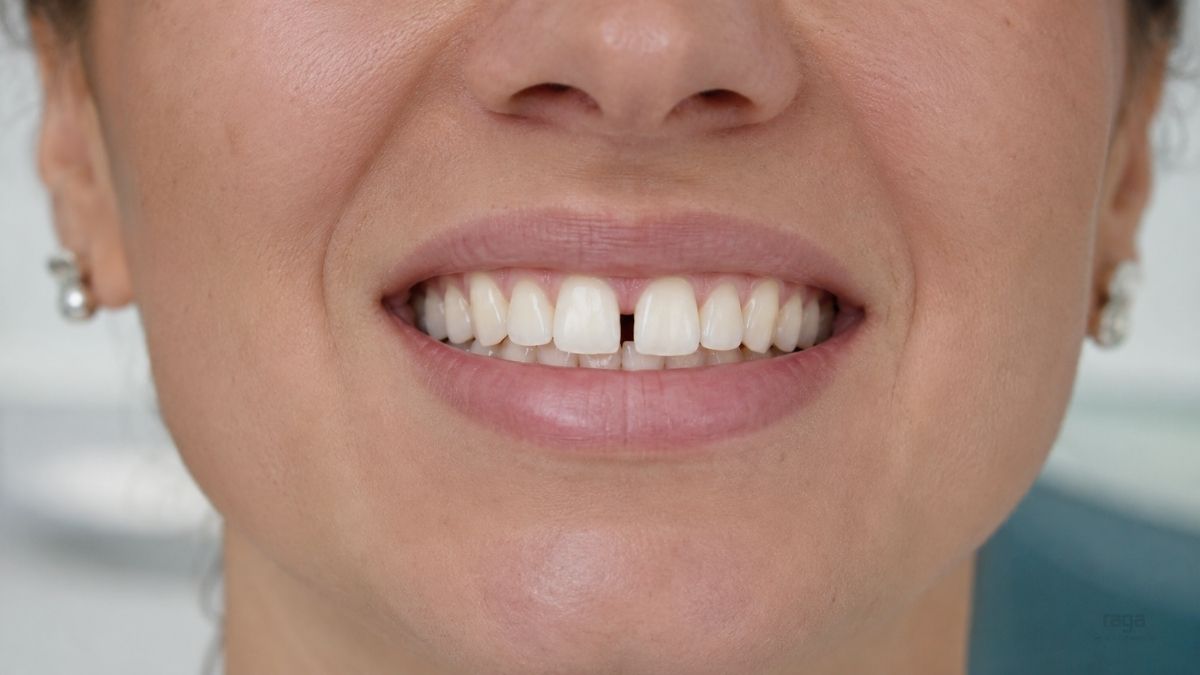 Dientes separados o diastemas